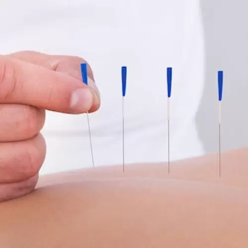 Akupunktur                           